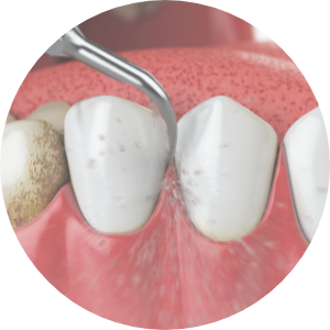 Mir Implant System image2